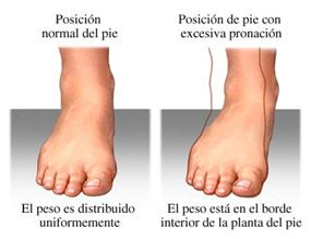 La fascitis plantar