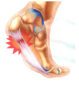 La fascitis plantar es una inflamación aguda de la aponeurosis plantar del pie.